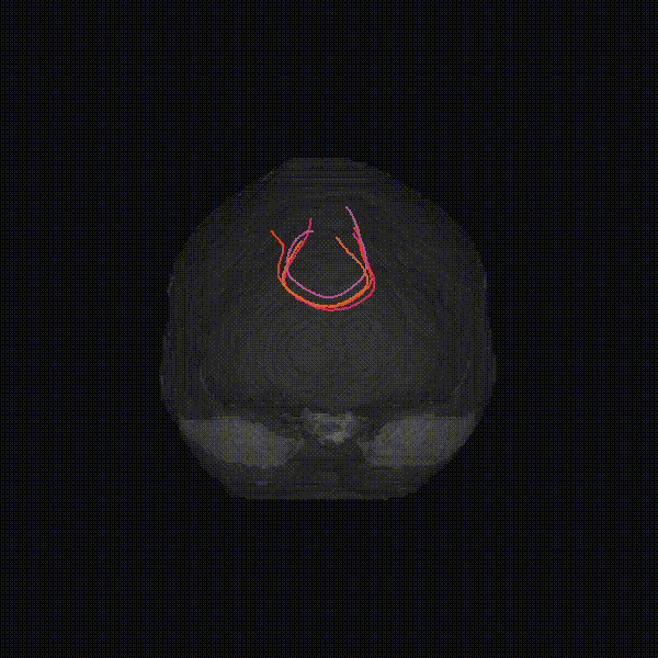 GenTract generated tractography